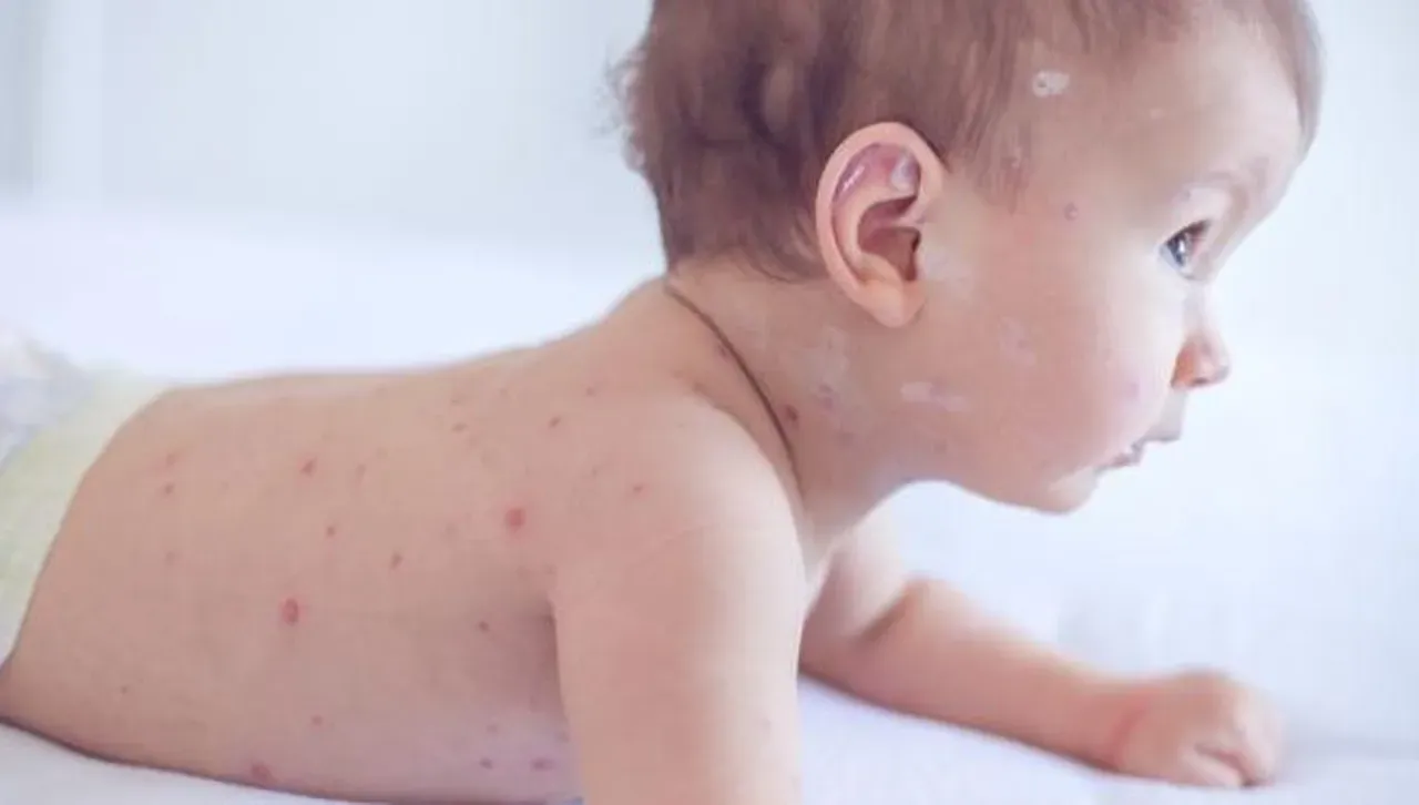 Второ дете почина в САЩ от морбили, над 600 са заразените - 97% не са ваксинирани