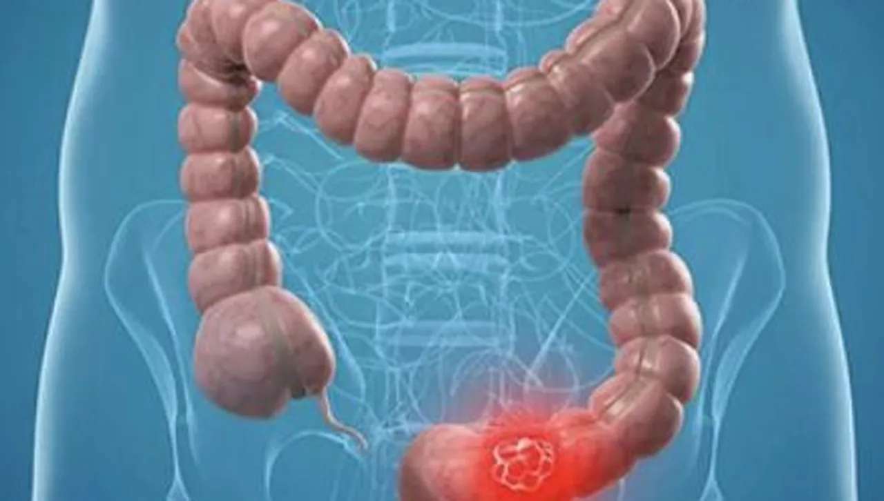 Движение срещу рецидив: как упражненията удължават живота след рак на дебелото черво